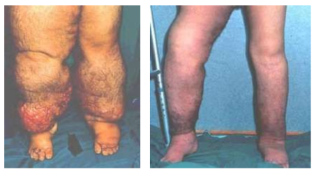 pernas-fibroticas
