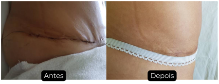 antes-e-depois